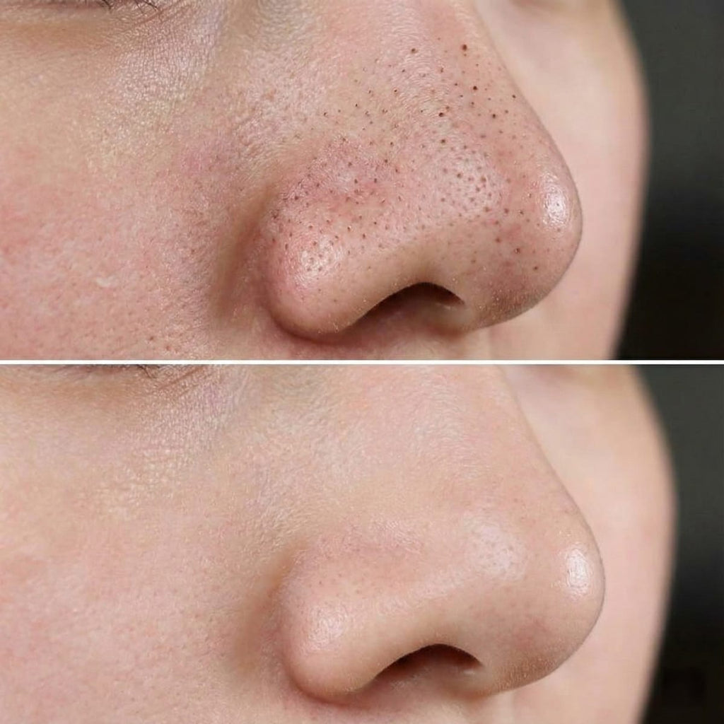 Aparat profesional curatare faciala cu vacuum pentru puncte negre, ingrijire ten, curatare profunda si masaj facial